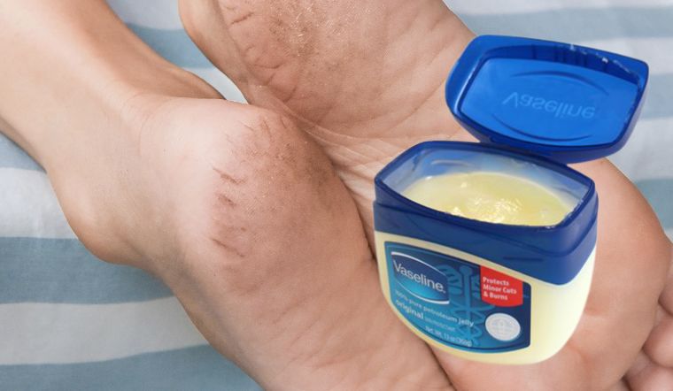 Cách chữa trị gót chân hiệu quả bằng kem bôi đặc trị